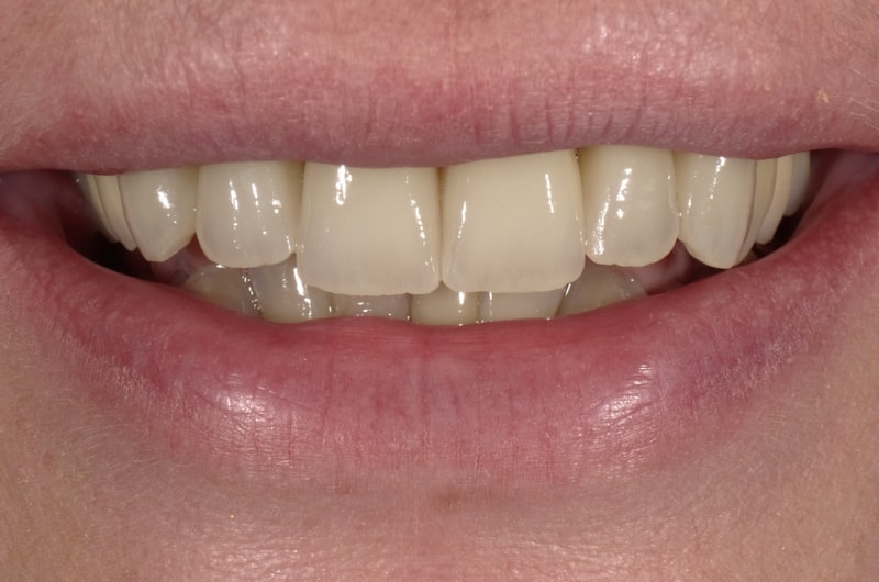 Entfernung des wurzelbehandelten Zahnes; Sofort-Implantat und leuchtende Vollkeramik-Kronen